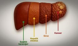 GÜNÜMÜZDE YAĞLI KARACİĞERE BAĞLI SİROZ ARTIYOR