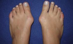 HALLUKS VALGUS AMELİYATI NE ZAMAN GEREKİR?