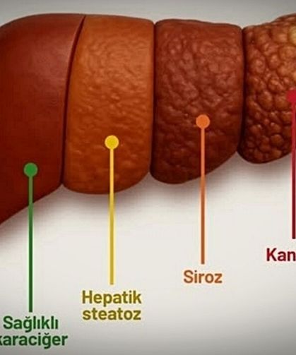 GÜNÜMÜZDE YAĞLI KARACİĞERE BAĞLI SİROZ ARTIYOR
