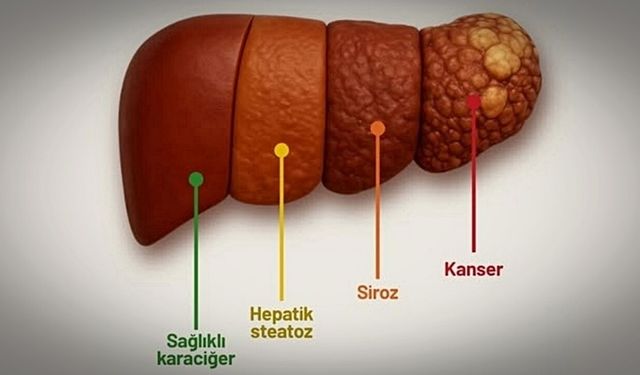 GÜNÜMÜZDE YAĞLI KARACİĞERE BAĞLI SİROZ ARTIYOR