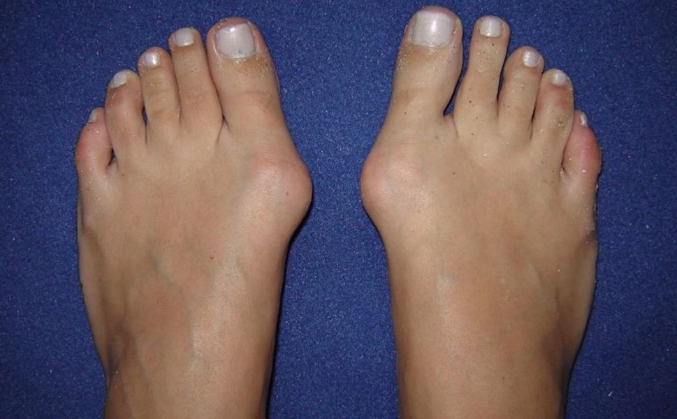HALLUKS VALGUS AMELİYATI NE ZAMAN GEREKİR?